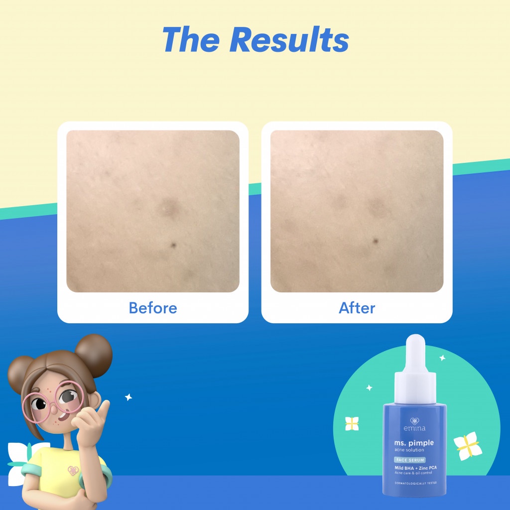 Emina Ms. Pimple Acne Solution Face Serum 30ml