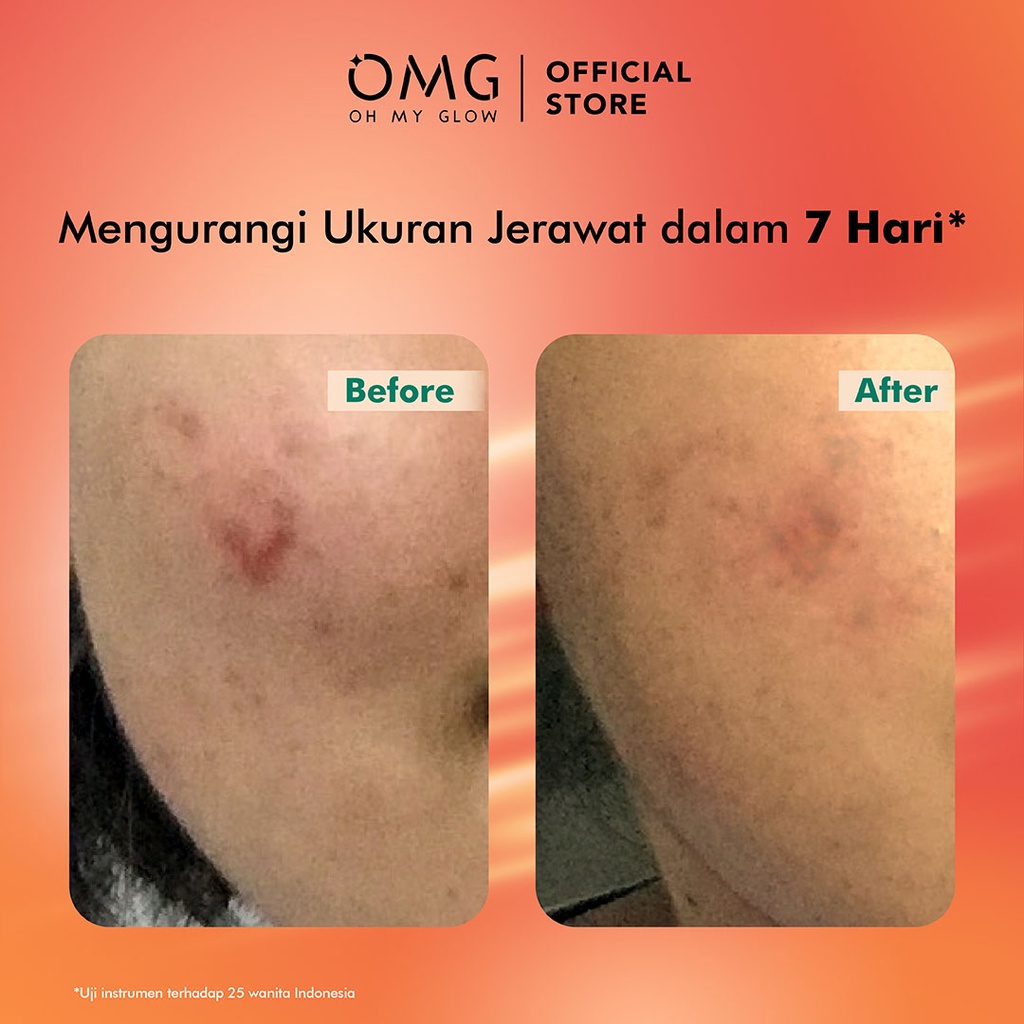 Oh My Glow Serum 20ml - Mugwort Acne Serum (OMG)