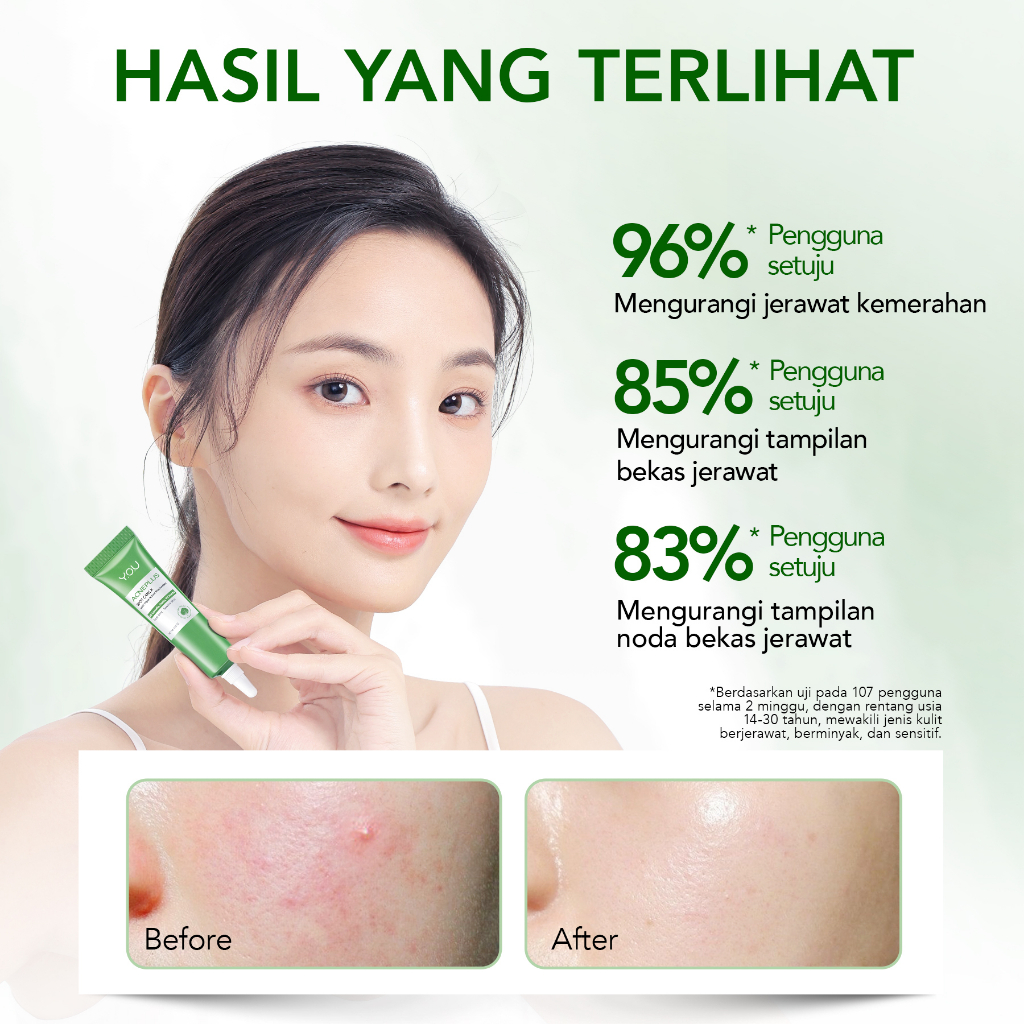 YOU Acneplus Triple Action Spot Care X 15gr