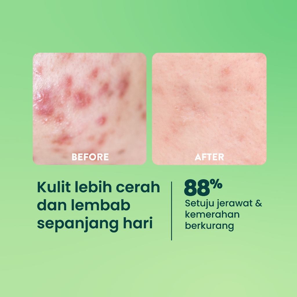 Npure Acne Care Bundling - Centella Acne Toner, Acne Biome Serum, Acne Clear Moisturizer (Buy 2 Free 1)